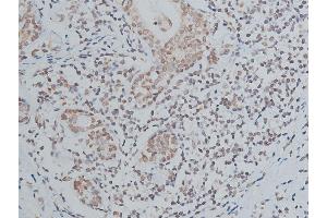 ABIN6267039 at 1/200 staining human breast cancer tissue sections by IHC-P.