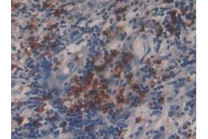 Detection of MMP9 in Human Lung cancer Tissue using Polyclonal Antibody to Matrix Metalloproteinase 9 (MMP9)