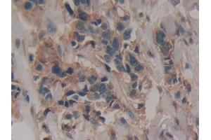 Detection of PPARa in Human Breast cancer Tissue using Polyclonal Antibody to Peroxisome Proliferator Activated Receptor Alpha (PPARa)