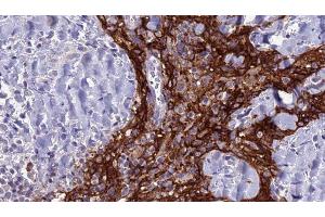 ABIN6279127 at 1/100 staining Human Head and neck cancer tissue by IHC-P. (SLC4A3 anticorps  (N-Term))