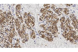Human parathyroid adenoma: immunohistochemical staining for Parathyroid Hormone.