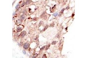 IHC analysis of FFPE human breast carcinoma tissue stained with the SUV39H2 antibody