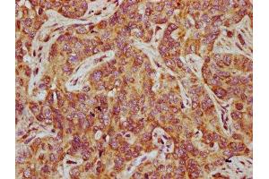 IHC image of ABIN7165837 diluted at 1:500 and staining in paraffin-embedded human liver cancer performed on a Leica BondTM system. (NTAN1 anticorps  (AA 219-310))