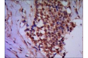 IHC of paraffin-embedded human breast cancer using anti-Protein Phosphatase 4C mouse mAb diluted 1/500-1/1000. (Protein Phosphatase 4C anticorps)