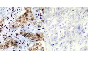 Immunohistochemical analysis of paraffin- embedded human breast carcinoma tissue using Abl1 (Ab-412) antibody (E022002). (ABL1 anticorps)
