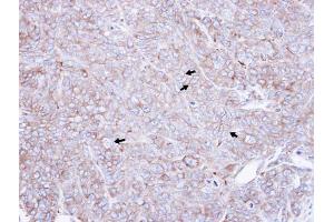 IHC-P Image Immunohistochemical analysis of paraffin-embedded DLD1 xenograft , using CAP1, antibody at 1:500 dilution. (CAP1 anticorps  (Center))