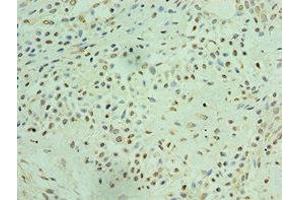 Immunohistochemistry of paraffin-embedded human breast cancer using ABIN7172050 at dilution of 1:100 (THOC1 anticorps  (AA 428-657))
