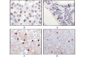 Immunohistochemical analysis of paraffin-embedded human liver carcinoma (A), recturn carcinoma (B), normal medulla tissue (C) and normal interbrain tissues (D), showing nuclear localization using Tip60 antibody with DAB staining. (KAT5 anticorps)