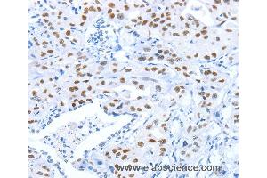 Immunohistochemistry of Human gastric cancer using ARID1A Polyclonal Antibody at dilution of 1:80 (ARID1A anticorps)