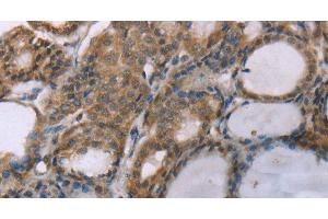 Immunohistochemistry of paraffin-embedded Human thyroid cancer using ACTN2 Polyclonal Antibody at dilution of 1:30