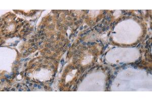 Immunohistochemistry of paraffin-embedded Human thyroid cancer using ACTN2 Polyclonal Antibody at dilution of 1:30 (ACTN2 anticorps)