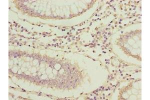 Immunohistochemistry of paraffin-embedded human colon cancer using ABIN7144631 at dilution of 1:100