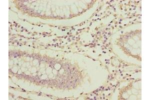 Immunohistochemistry of paraffin-embedded human colon cancer using ABIN7144631 at dilution of 1:100 (ARPIN anticorps  (AA 1-226))
