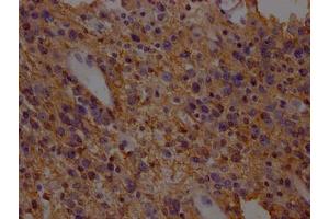 IHC image of ABIN7152226 diluted at 1:200 and staining in paraffin-embedded human glioma cancer performed on a Leica BondTM system.