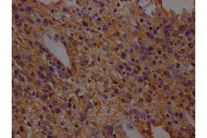 IHC image of ABIN7152226 diluted at 1:200 and staining in paraffin-embedded human glioma cancer performed on a Leica BondTM system. (SLC1A3 anticorps  (AA 146-236))