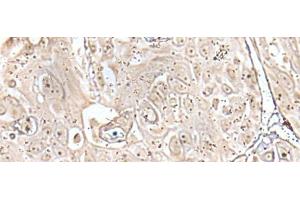 Immunohistochemistry of paraffin-embedded Human esophagus cancer tissue using VRK3 Polyclonal Antibody at dilution of 1:45(x200) (VRK3 anticorps)