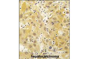 Formalin-fixed and paraffin-embedded human hepatocarcinoma tissue reacted with Tiparp antibody , which was peroxidase-conjugated to the secondary antibody, followed by DAB staining. (Tiparp anticorps  (N-Term))