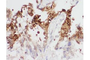 Anti-PGK1 antibody, IHC(P) IHC(P): Human Lung Cancer Tissue