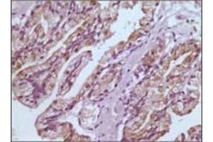 Immunohistochemical analysis of paraffin-embedded human prostate tissues using GSTP1 antibody with DAB staining. (GSTP1 anticorps)