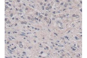 DAB staining on IHC-P; Samples: Human Prostate cancer Tissue