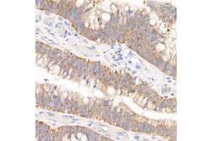 Immunohistochemistry of paraffin-embedded human colon carcinoma using GFPT1 Rabbit mAb (ABIN7267430) at dilution of 1:150 (40x lens). (GFPT1 anticorps)