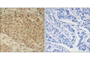 Immunohistochemical analysis of paraffin-embedded human breast carcinoma tissue using Smad2 (Ab-220) Antibody (E021323). (SMAD2 anticorps)