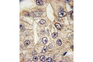 Formalin-fixed and paraffin-embedded human lung carcinoma tissue reacted with CD14 antibody , which was peroxidase-conjugated to the secondary antibody, followed by DAB staining.