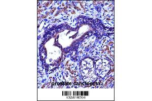 ACTG2 Antibody immunohistochemistry analysis in formalin fixed and paraffin embedded human prostate cancinoma followed by peroxidase conjugation of the secondary antibody and DAB staining. (ACTG2 anticorps  (C-Term))