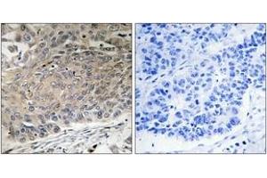Immunohistochemistry analysis of paraffin-embedded human lung carcinoma tissue, using DYNLL2 Antibody. (DYNLL2 anticorps  (AA 1-50))
