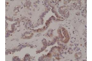 IHC testing of formalin fixed and paraffin embedded human thyroid cancer tissue with recombinant phospho-EIF2A antibody at 1:200 dilution. (Recombinant EIF2A anticorps  (pSer51))
