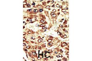 Formalin-fixed and paraffin-embedded human hepatocellular carcinoma tissue reacted with WEE1 polyclonal antibody  , which was peroxidase-conjugated to the secondary antibody, followed by AEC staining. (WEE1 anticorps  (C-Term))