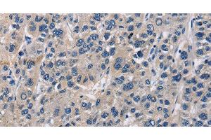 Immunohistochemistry of paraffin-embedded Human liver cancer tissue using ABI3BP Polyclonal Antibody at dilution 1:60 (ABI3BP anticorps)