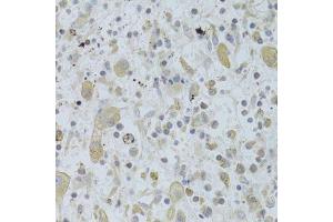 Immunohistochemistry of paraffin-embedded human liver cancer using MAP2K5 Antibody. (MAP2K5 anticorps  (AA 1-190))