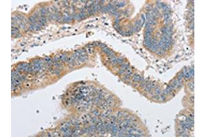 The image on the left is immunohistochemistry of paraffin-embedded Human colon cancer tissue using ABIN7128507(ARHGEF9 Antibody) at dilution 1/50, on the right is treated with fusion protein. (Arhgef9 anticorps)