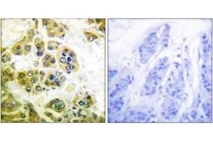 Immunohistochemistry analysis of paraffin-embedded human breast carcinoma tissue, using IKK-alpha/beta (Ab-180/181) Antibody.