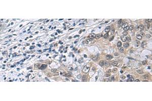 Immunohistochemistry of paraffin-embedded Human esophagus cancer tissue using IRS4 Polyclonal Antibody at dilution of 1:45(x200) (IRS4 anticorps)