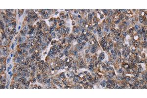 Immunohistochemistry of paraffin-embedded Human ovarian cancer tissue using LDOC1 Polyclonal Antibody at dilution 1:50 (LDOC1 anticorps)