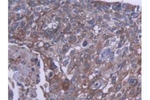 Detection of CES1 in Human Lung cancer Tissue using Polyclonal Antibody to Carboxylesterase 1 (CES1)