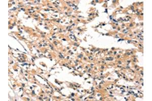 The image on the left is immunohistochemistry of paraffin-embedded Human thyroid cancer tissue using ABIN7190422(CYP46A1 Antibody) at dilution 1/15, on the right is treated with synthetic peptide. (CYP46A1 anticorps)