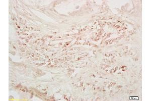 Formalin-fixed and paraffin embedded human colon carcinoma tissue labeled Anti-GM-CSFR alpha/CD116/CSF2RA Polyclonal Antibody, Unconjugated (ABIN686812) at 1:200, followed by conjugation to the secondary antibody and DAB staining