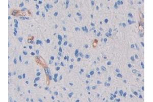 Detection of GC in Human Glioma Tissue using Polyclonal Antibody to Glycocalicin (GC) (Glycocalicin anticorps  (AA 136-276))