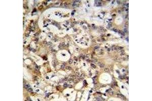 SP1 antibody immunohistochemistry analysis in formalin fixed and paraffin embedded human colon carcinoma. (SP1 anticorps  (AA 677-707))