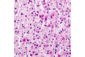 Immunohistochemical analysis of Connexin 32 staining in human liver cancer formalin fixed paraffin embedded tissue section.