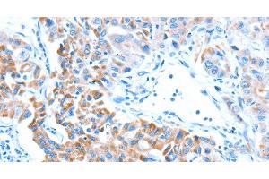 Immunohistochemistry of paraffin-embedded Human lung cancer tissue using ALDH5A1 Polyclonal Antibody at dilution 1:60 (ALDH5A1 anticorps)