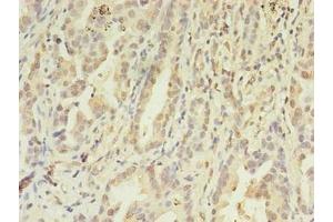 Immunohistochemistry of paraffin-embedded human lung cancer using ABIN7152867 at dilution of 1:100 (FGL2 anticorps  (AA 24-439))