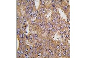 Formalin-fixed and paraffin-embedded human prostata carcinoma tissue reacted with NARS2 antibody (C-term), which was peroxidase-conjugated to the secondary antibody, followed by DAB staining. (NASP anticorps  (C-Term))