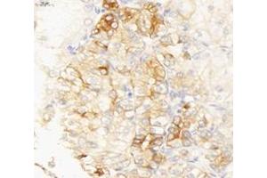 Immunohistochemistry analysis of paraffin-embedded human endometrial cancer using INSR (ABIN7074298) at dilution of 1: 6000