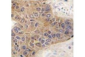 IHC analysis of FFPE human hepatocarcinoma tissue stained with STUB1 antibody (STUB1 anticorps  (AA 203-231))