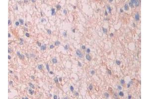 Detection of SAP in Human Glioma Tissue using Polyclonal Antibody to Serum Amyloid P Component (SAP) (APCS anticorps  (AA 23-223))