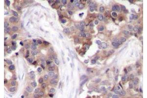 Immunohistochemistry of paraffin-embedded Human breast carcinoma using Phospho-STMN1(S25) Polyclonal Antibody